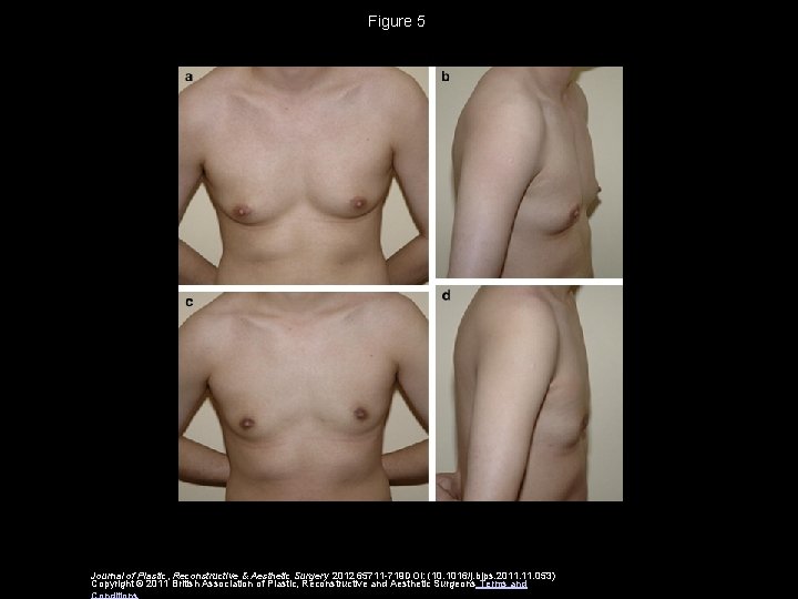 Figure 5 Journal of Plastic, Reconstructive & Aesthetic Surgery 2012 65711 -719 DOI: (10.