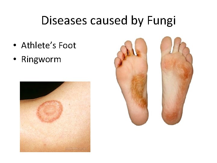Diseases caused by Fungi • Athlete’s Foot • Ringworm 