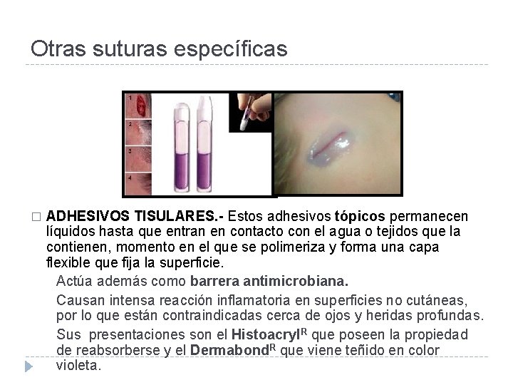 Otras suturas específicas � ADHESIVOS TISULARES. - Estos adhesivos tópicos permanecen líquidos hasta que