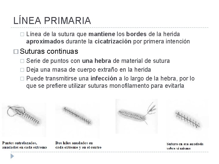 LÍNEA PRIMARIA � Línea de la sutura que mantiene los bordes de la herida