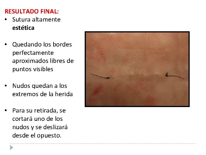 RESULTADO FINAL: • Sutura altamente estética • Quedando los bordes perfectamente aproximados libres de