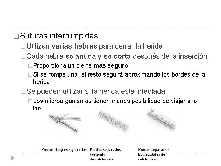 � Suturas interrumpidas � Utilizan varias hebras para cerrar la herida � Cada hebra