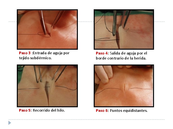 Paso 3 : Entrada de aguja por tejido subdérmico. Paso 4: Salida de aguja