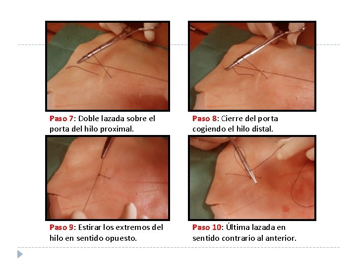 Paso 7: Doble lazada sobre el porta del hilo proximal. Paso 8: Cierre del