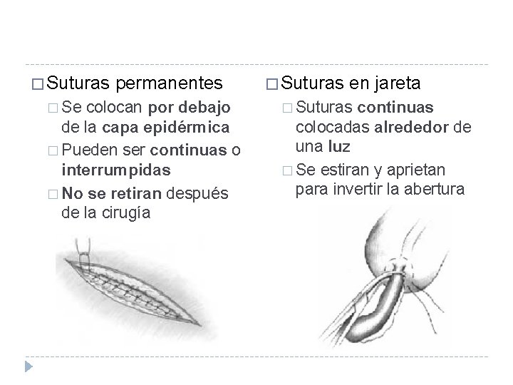 � Suturas � Se permanentes colocan por debajo de la capa epidérmica � Pueden
