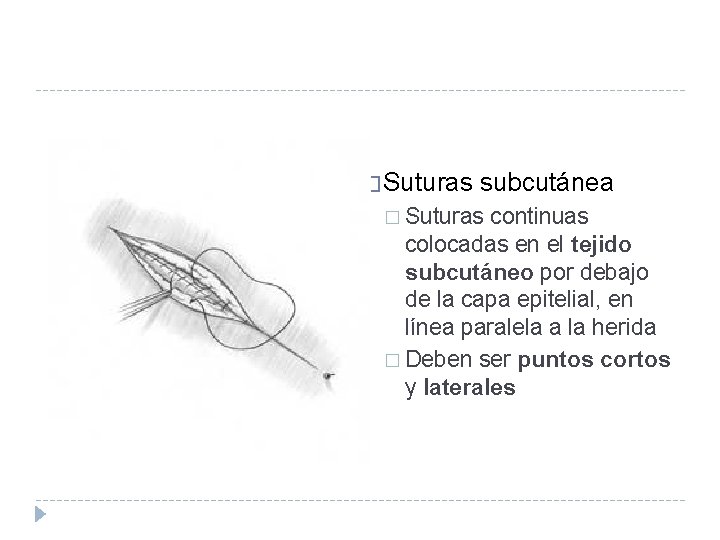 � Suturas subcutánea � Suturas continuas colocadas en el tejido subcutáneo por debajo de