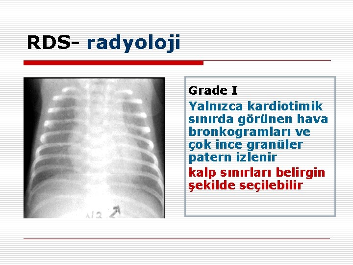 RDS- radyoloji Grade I Yalnızca kardiotimik sınırda görünen hava bronkogramları ve çok ince granüler