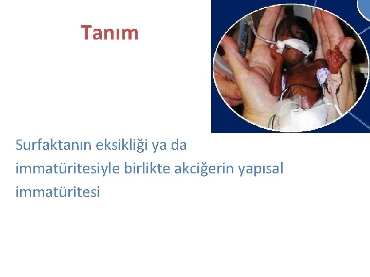 Tanım Surfaktanın eksikliği ya da immatüritesiyle birlikte akciğerin yapısal immatüritesi 