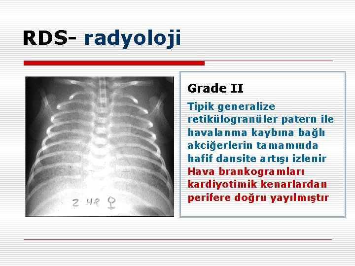 RDS- radyoloji Grade II Tipik generalize retikülogranüler patern ile havalanma kaybına bağlı akciğerlerin tamamında