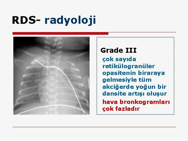 RDS- radyoloji Grade III çok sayıda retikülogranüler opasitenin biraraya gelmesiyle tüm akciğerde yoğun bir