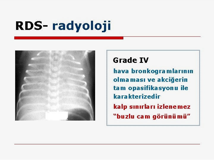 RDS- radyoloji Grade IV hava bronkogramlarının olmaması ve akciğerin tam opasifikasyonu ile karakterizedir kalp