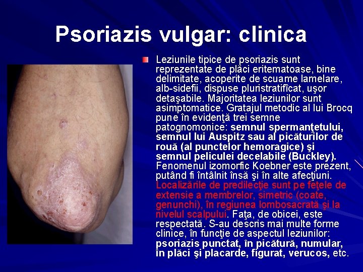 Psoriazis vulgar: clinica Leziunile tipice de psoriazis sunt reprezentate de plăci eritematoase, bine delimitate,