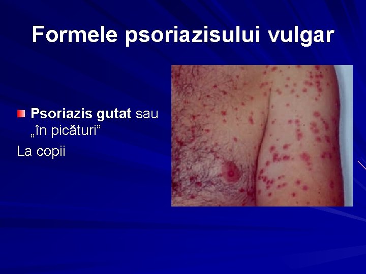 Formele psoriazisului vulgar Psoriazis gutat sau „în picături” La copii 
