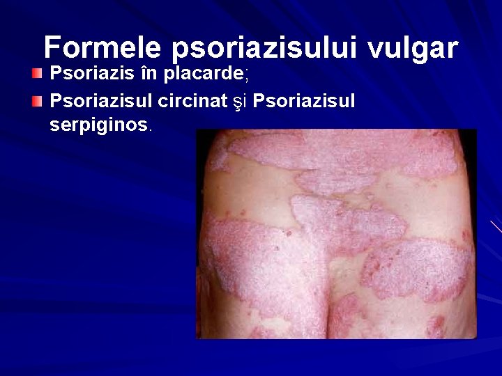 Formele psoriazisului vulgar Psoriazis în placarde; Psoriazisul circinat şi Psoriazisul serpiginos. 