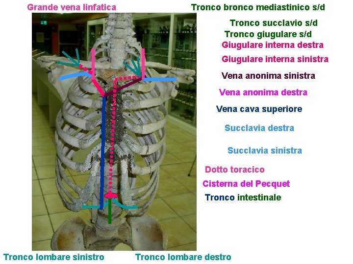 Grande vena linfatica Tronco bronco mediastinico s/d Tronco succlavio s/d Tronco giugulare s/d Giugulare