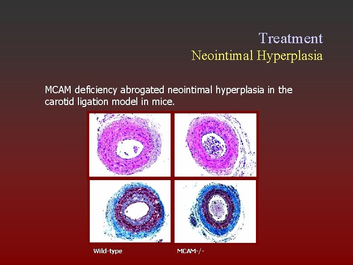 Treatment Neointimal Hyperplasia MCAM deficiency abrogated neointimal hyperplasia in the carotid ligation model in