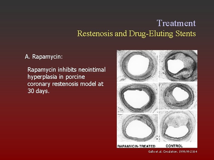 Treatment Restenosis and Drug-Eluting Stents A. Rapamycin: Rapamycin inhibits neointimal hyperplasia in porcine coronary