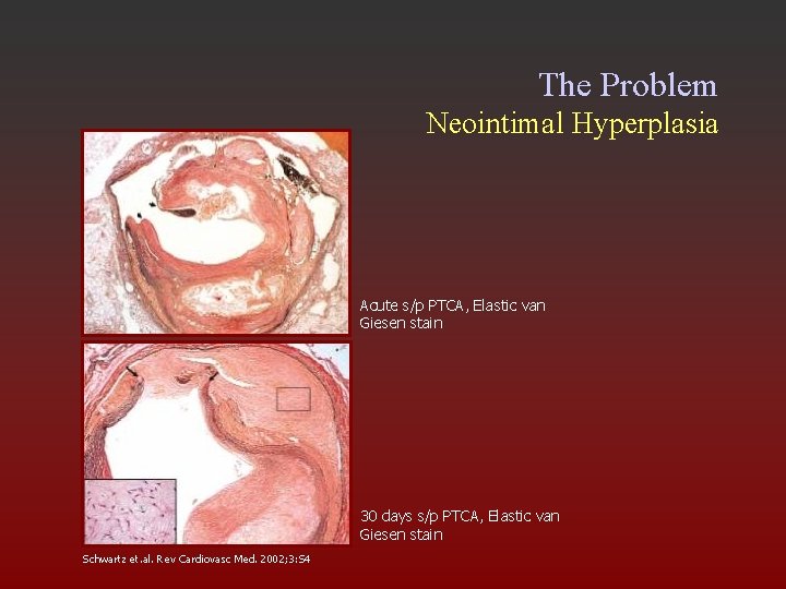 The Problem Neointimal Hyperplasia Acute s/p PTCA, Elastic van Giesen stain 30 days s/p