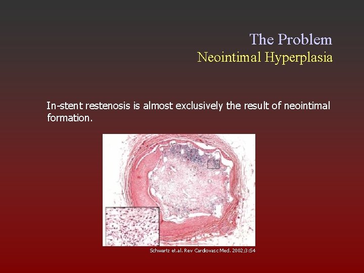 The Problem Neointimal Hyperplasia In-stent restenosis is almost exclusively the result of neointimal formation.