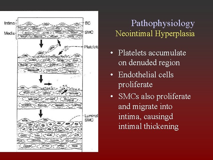 Pathophysiology Neointimal Hyperplasia • Platelets accumulate on denuded region • Endothelial cells proliferate •