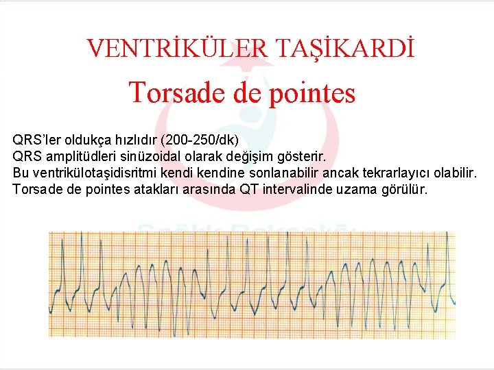 VENTRİKÜLER TAŞİKARDİ Torsade de pointes QRS’ler oldukça hızlıdır (200 -250/dk) QRS amplitüdleri sinüzoidal olarak