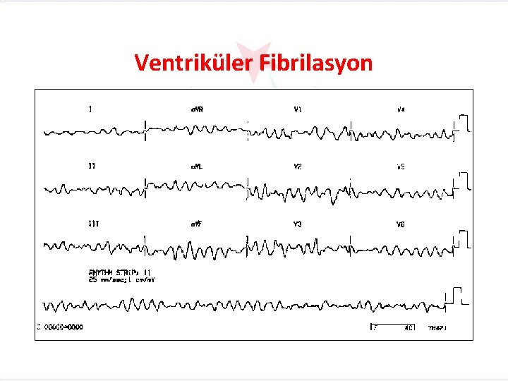 Ventriküler Fibrilasyon 