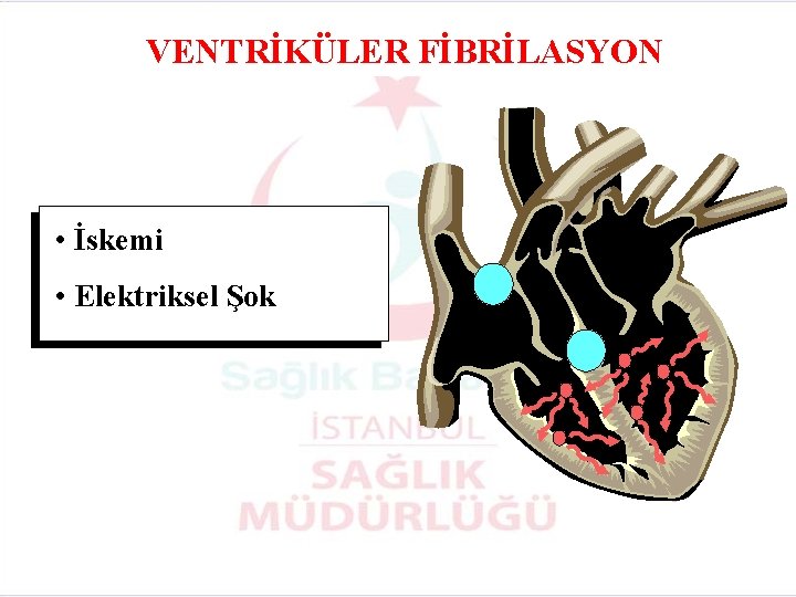 VENTRİKÜLER FİBRİLASYON • İskemi • Elektriksel Şok 