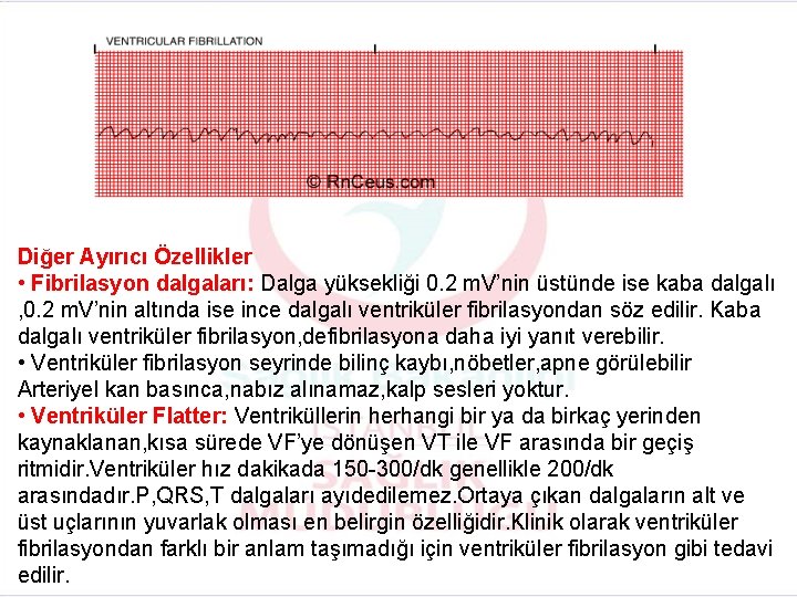 Diğer Ayırıcı Özellikler • Fibrilasyon dalgaları: Dalga yüksekliği 0. 2 m. V’nin üstünde ise