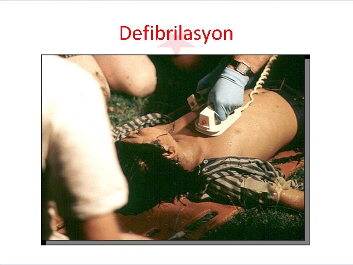 Defibrilasyon 