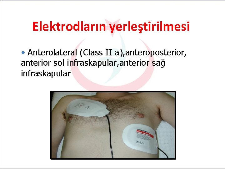 Elektrodların yerleştirilmesi • Anterolateral (Class II a), anteroposterior, anterior sol infraskapular, anterior sağ infraskapular