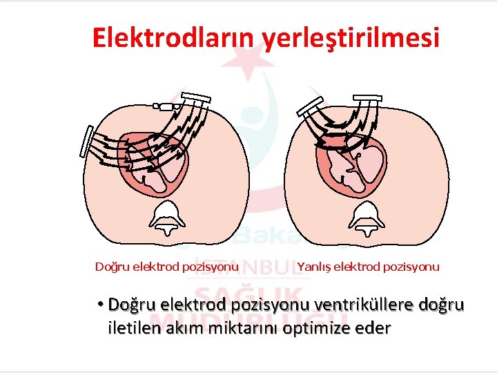 Elektrodların yerleştirilmesi Doğru elektrod pozisyonu Yanlış elektrod pozisyonu • Doğru elektrod pozisyonu ventriküllere doğru