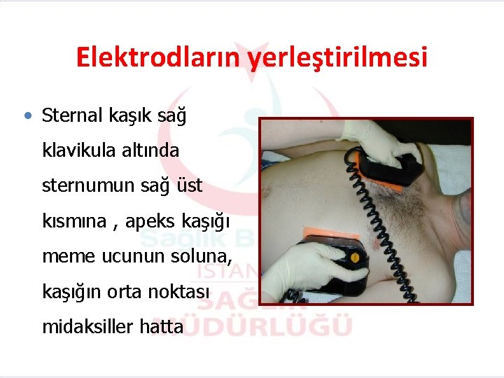 Elektrodların yerleştirilmesi • Sternal kaşık sağ klavikula altında sternumun sağ üst kısmına , apeks