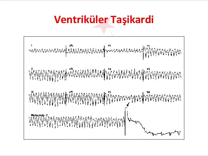 Ventriküler Taşikardi 