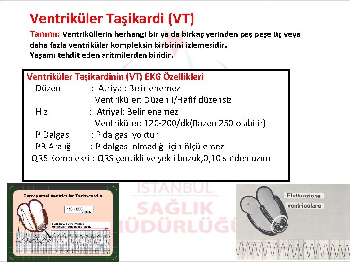 Ventriküler Taşikardi (VT) Tanımı: Ventriküllerin herhangi bir ya da birkaç yerinden peşe üç veya