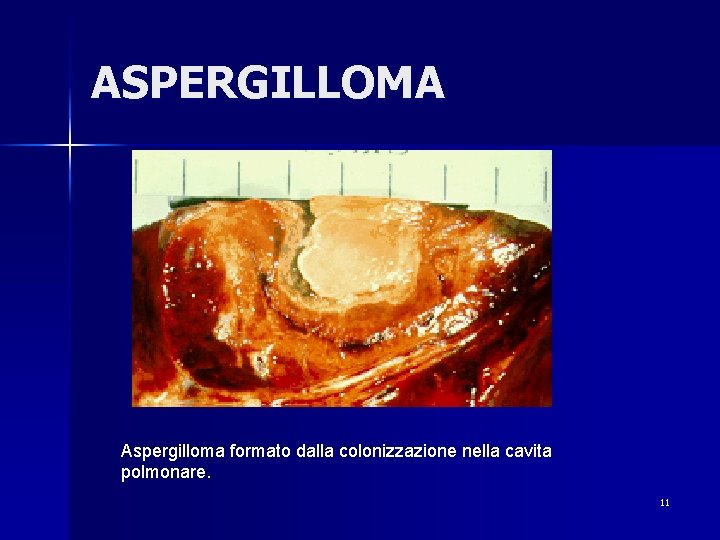 ASPERGILLOMA Aspergilloma formato dalla colonizzazione nella cavita polmonare. 11 