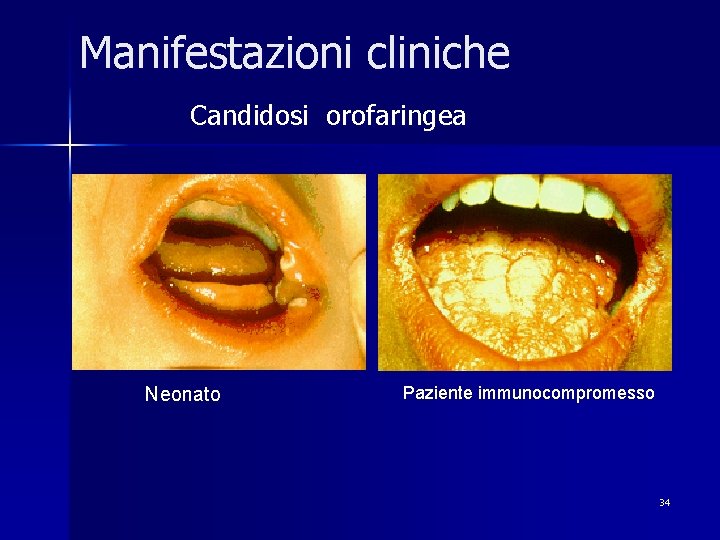 Manifestazioni cliniche Candidosi orofaringea Neonato Paziente immunocompromesso 34 