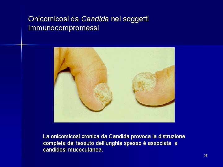 Onicomicosi da Candida nei soggetti immunocompromessi La onicomicosi cronica da Candida provoca la distruzione