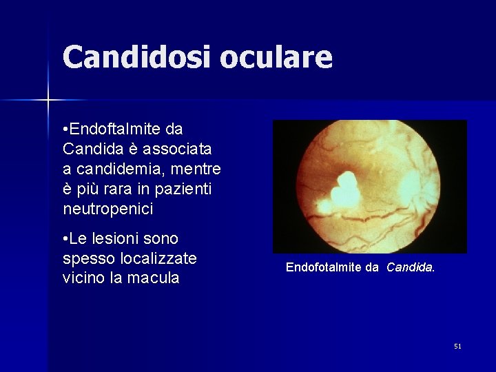 Candidosi oculare • Endoftalmite da Candida è associata a candidemia, mentre è più rara