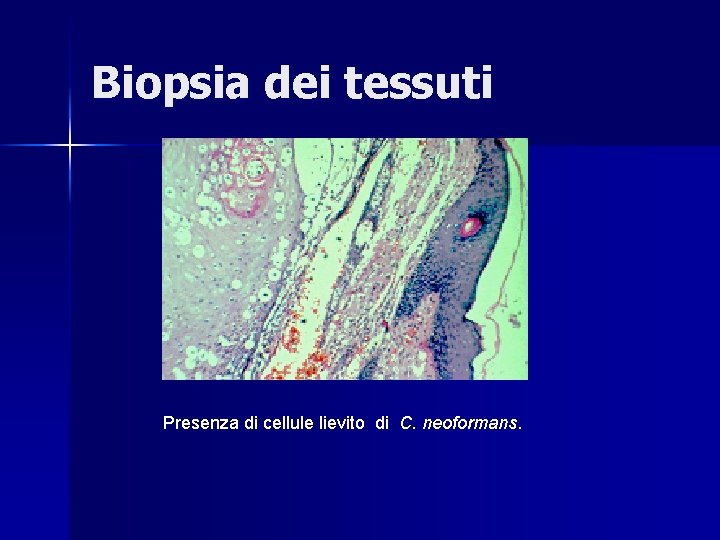 Biopsia dei tessuti Presenza di cellule lievito di C. neoformans. 