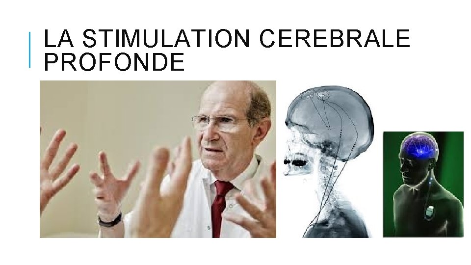 LA STIMULATION CEREBRALE PROFONDE LA STIMULATION CEREBRALE PROFONDE