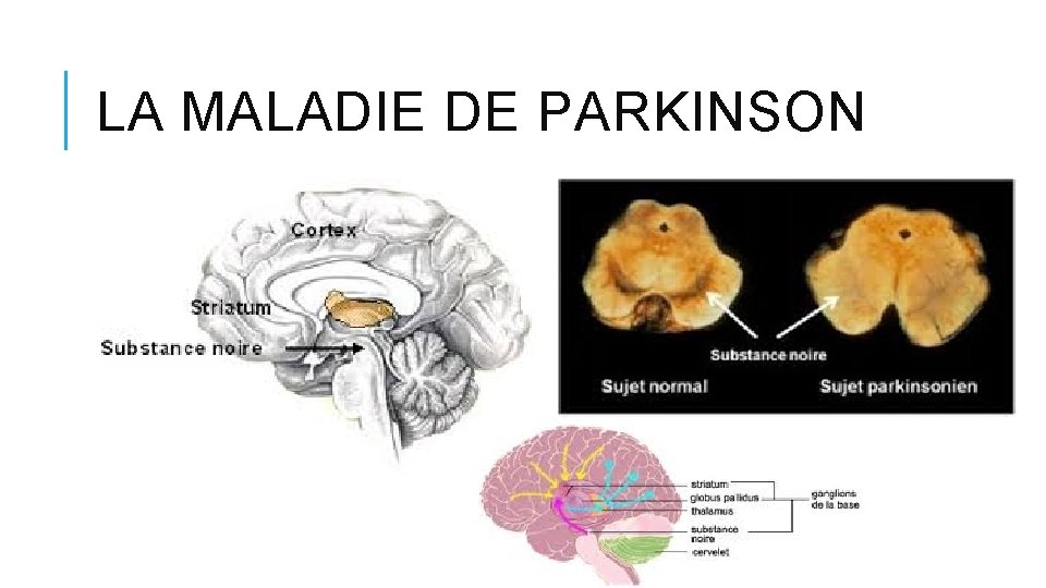 LA MALADIE DE PARKINSON LA MALADIE DE PARKINSON