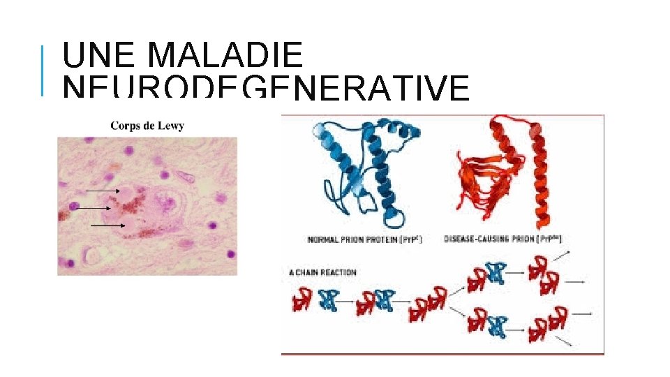 UNE MALADIE NEURODEGENERATIVE UNE MALADIE NEURODEGENERATIVE