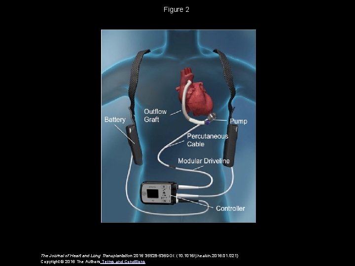 Figure 2 The Journal of Heart and Lung Transplantation 2016 35528 -536 DOI: (10.