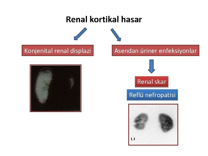 Renal kortikal hasar Konjenital renal displazi Asendan üriner enfeksiyonlar Renal skar Reflü nefropatisi 