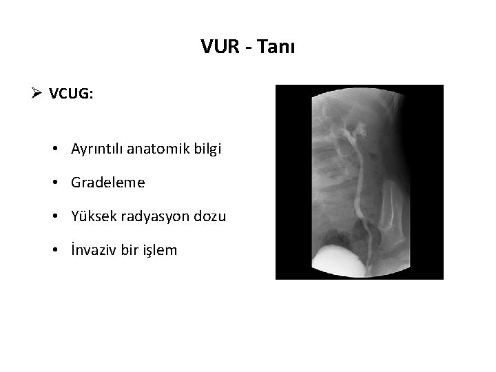 VUR - Tanı Ø VCUG: • Ayrıntılı anatomik bilgi • Gradeleme • Yüksek radyasyon