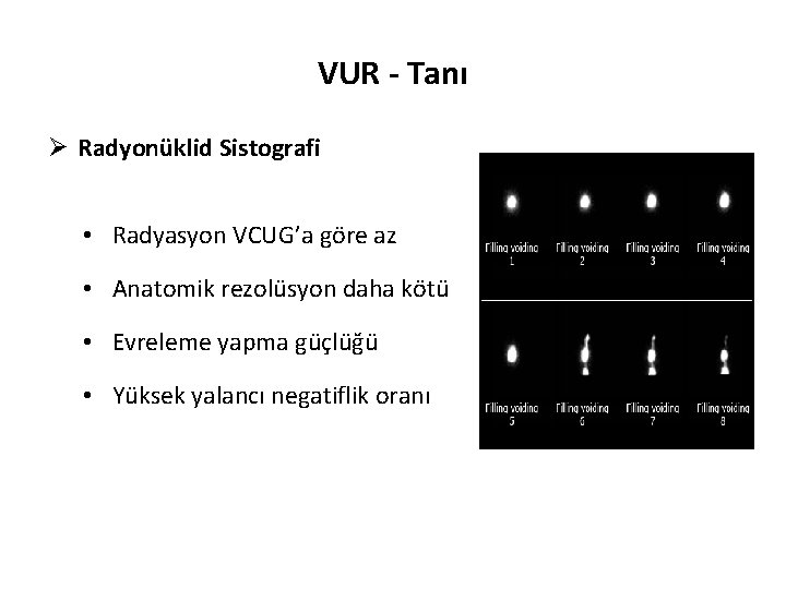 VUR - Tanı Ø Radyonüklid Sistografi • Radyasyon VCUG’a göre az • Anatomik rezolüsyon