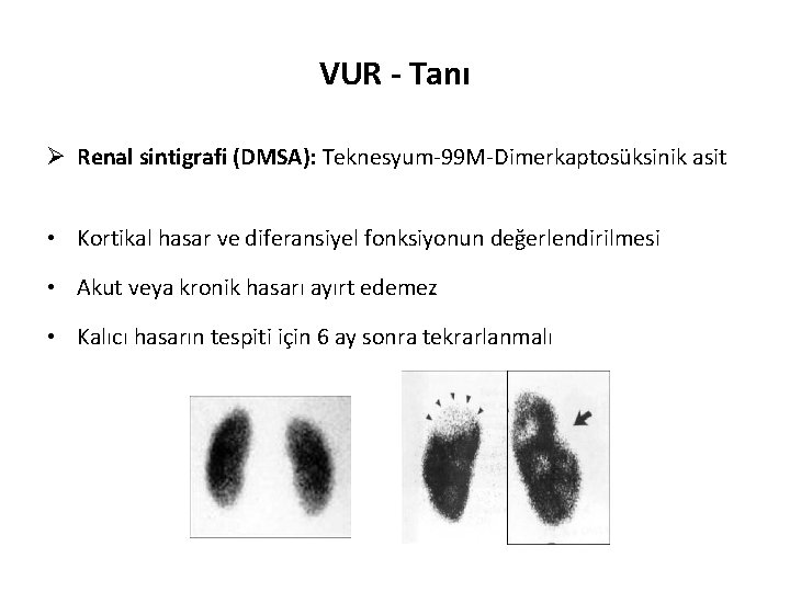 VUR - Tanı Ø Renal sintigrafi (DMSA): Teknesyum-99 M-Dimerkaptosüksinik asit • Kortikal hasar ve