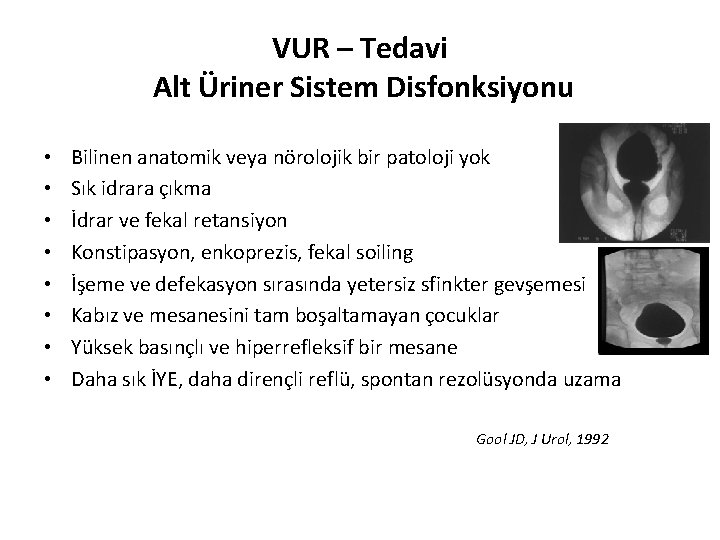 VUR – Tedavi Alt Üriner Sistem Disfonksiyonu • • Bilinen anatomik veya nörolojik bir