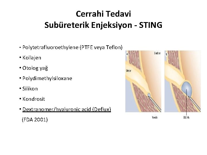 Cerrahi Tedavi Subüreterik Enjeksiyon - STING • Polytetrafluoroethylene (PTFE veya Teflon) • Kollajen •