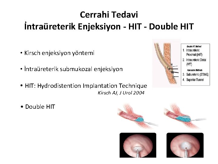 Cerrahi Tedavi İntraüreterik Enjeksiyon - HIT - Double HIT • Kirsch enjeksiyon yöntemi •